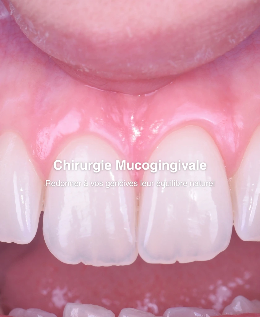 Chirurgie Mucogingivale