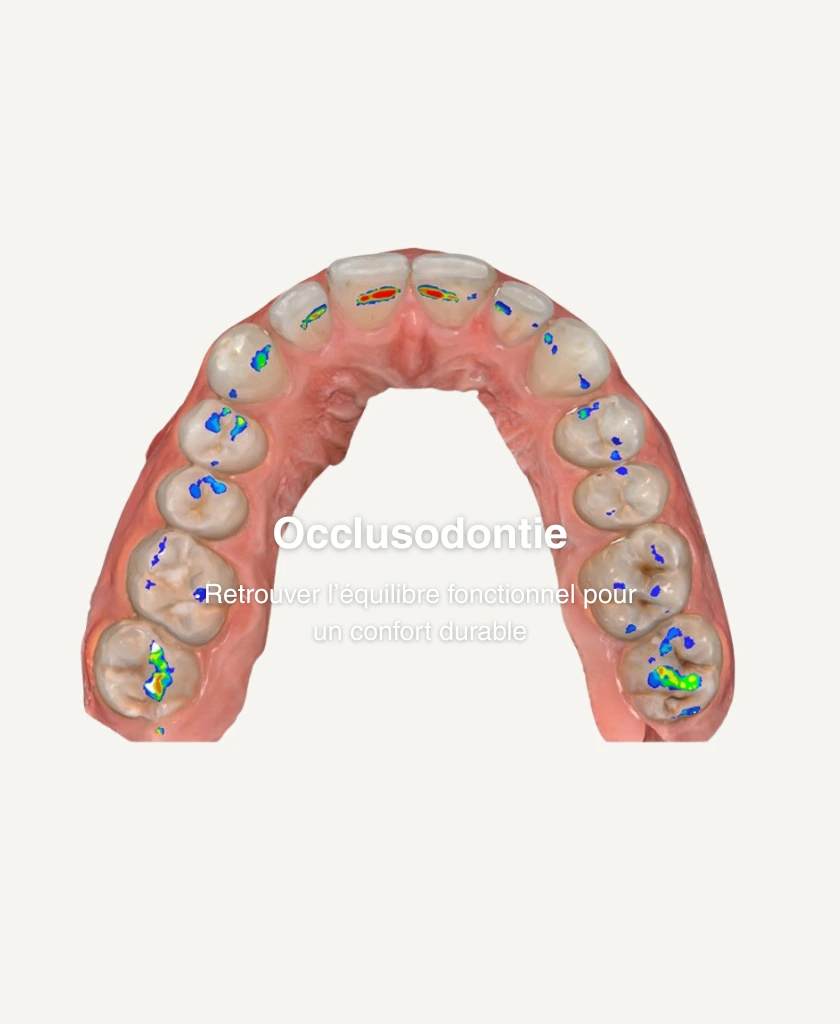 Occlusodontie